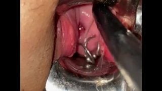 Sounding Her Uterus With Nice View On Her Second Uterus Piercing!