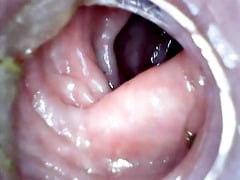 Anal endoscope part 2